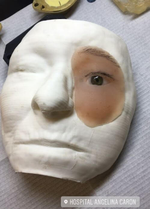 Prótese facial - Molde por Impressão 3D